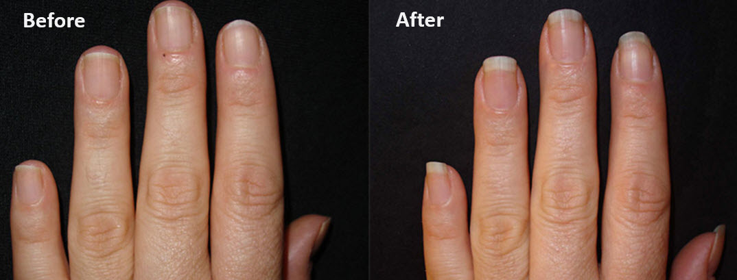 Low Keratin with low msm can lead to nail issues too