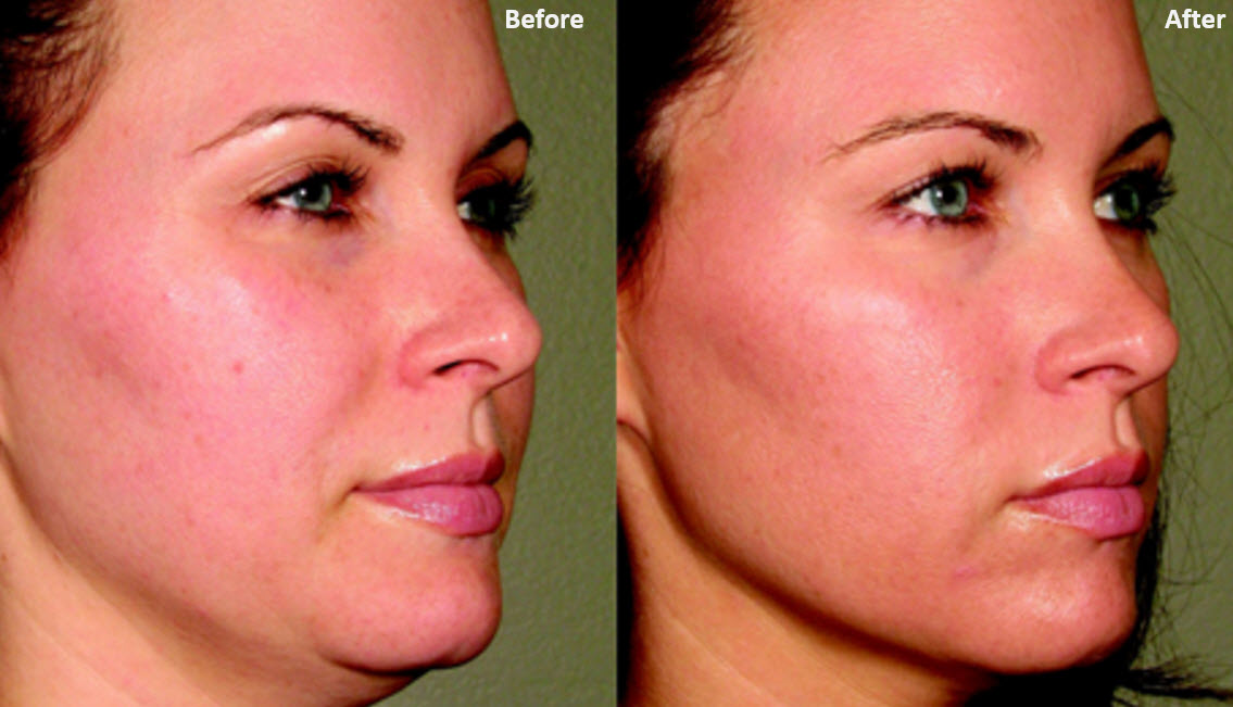 Complexion of skin and MSM