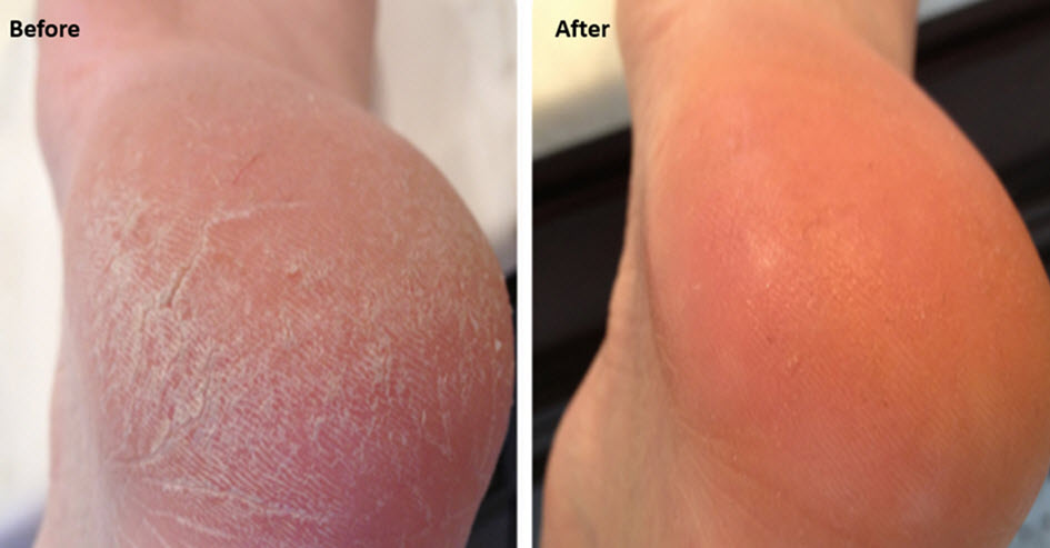 Dry, irritated skin and MSM